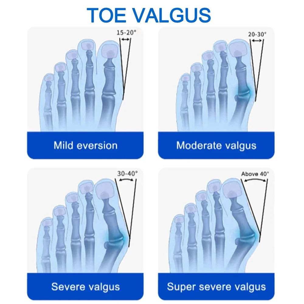 Hallux Valgus Correction