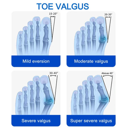 Hallux Valgus Correction